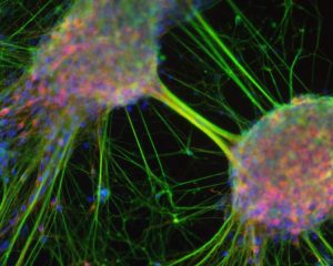 Gene-activity changes come before any visible differences in neurons.